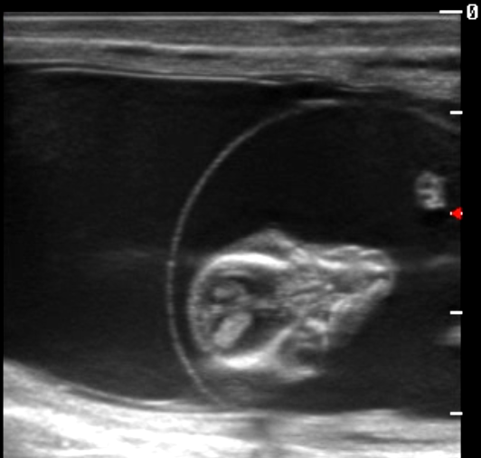 Black-and-white ultrasound image showing a first-trimester fetus within the gestational sac. The fetal head and upper body are visible in profile against the dark amniotic fluid, with no identifying information displayed.
